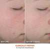 Dr. Dennis Gross Skincare Alpha Beta On The Spot Eliminator Gel para Acne con 2% de Ácido Salicílico