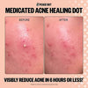 Peace Out Salicylic Acid Acne Healing Dots